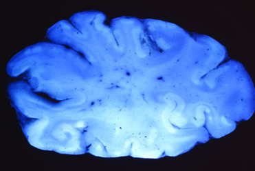 La materia gris necrótica se autoflorece con luz ultravioleta. En esta imagen, la polioencefalomalacia se puede ver como áreas fluorescentes de color blanco brillante en la materia gris cortical.